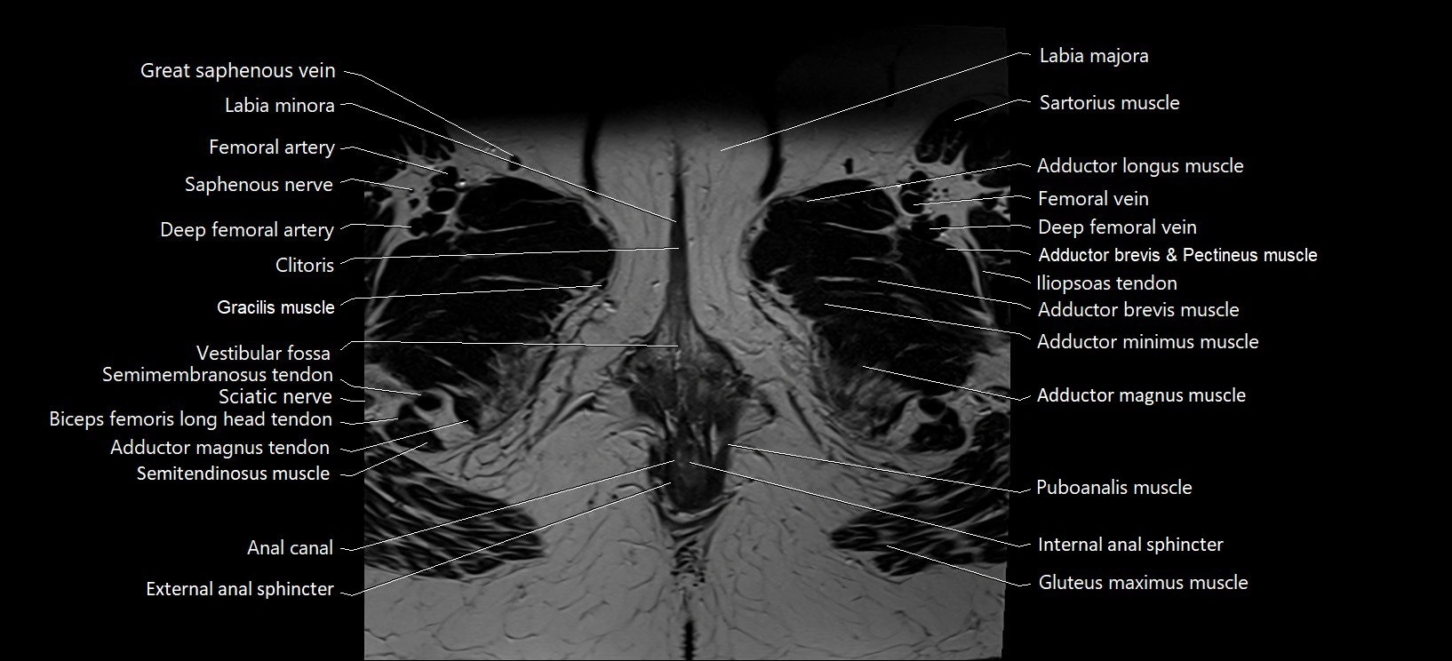 Axial cross sectional anatomy of female pelvis (MRI 3T) image 46.webp